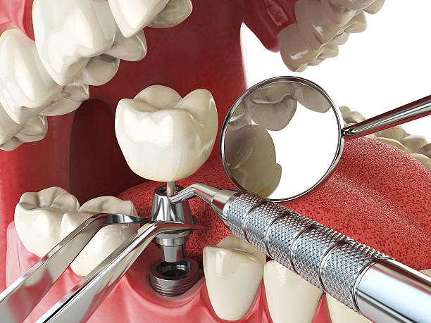Best Emergency Dental Extractions in Greenville, IN